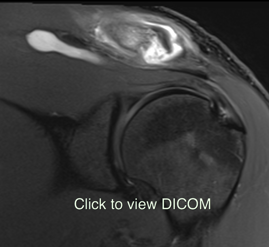ACJ disease