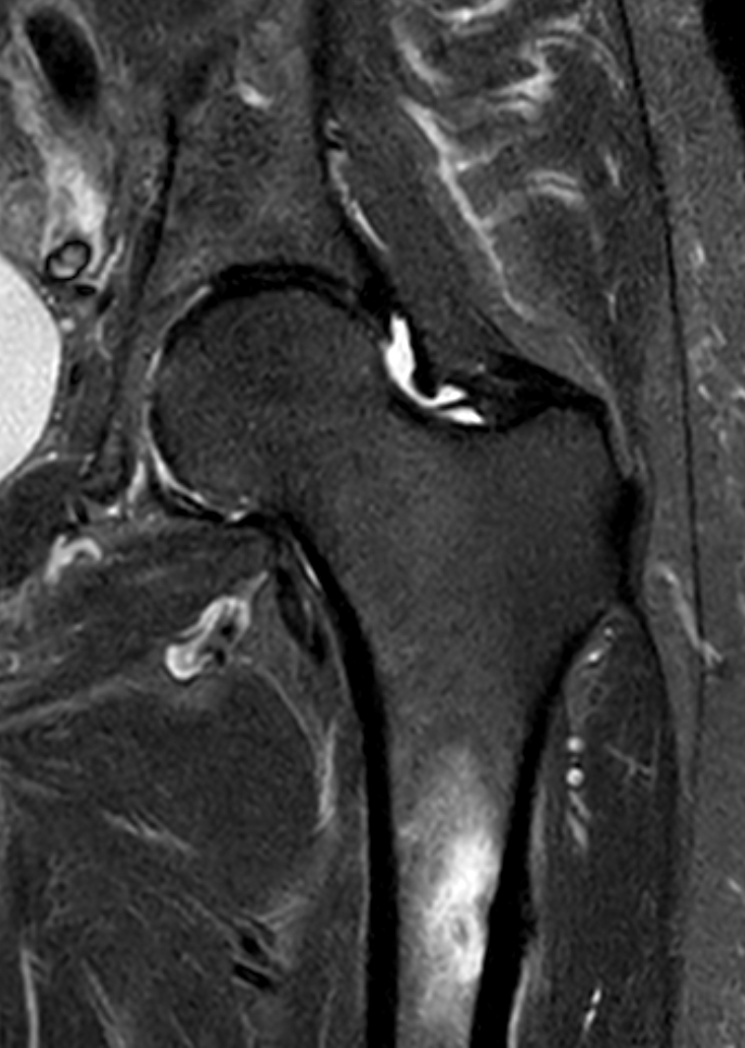
Atypical femoral fracture. Click for DICOM
