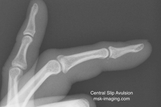 Central slip injury