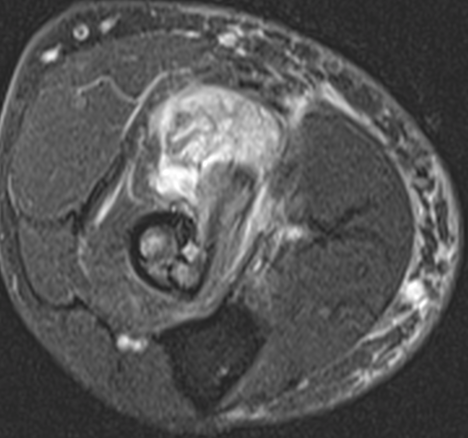 Cubital bursitis and biceps tendinopathy Click for DICOM