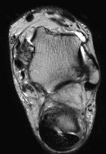 
Achilles tendinopathy and FHL Rupture. Click for DICOM
