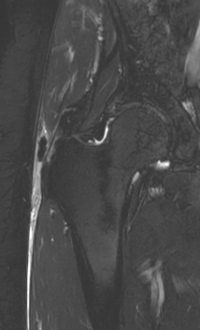 
Calcific tendinopathy. Click for DICOM 
