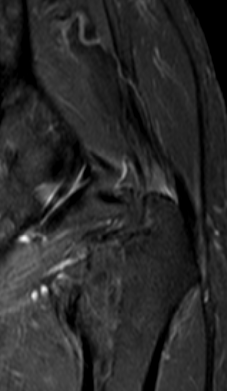 
Gluteus insertion disease. Click for DICOM 
