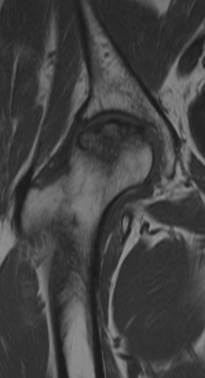 
Hip AVN Click for DICOM

