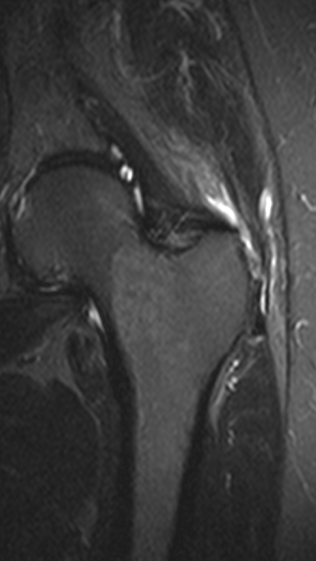 
Gluteus insertion disease. Click for DICOM
