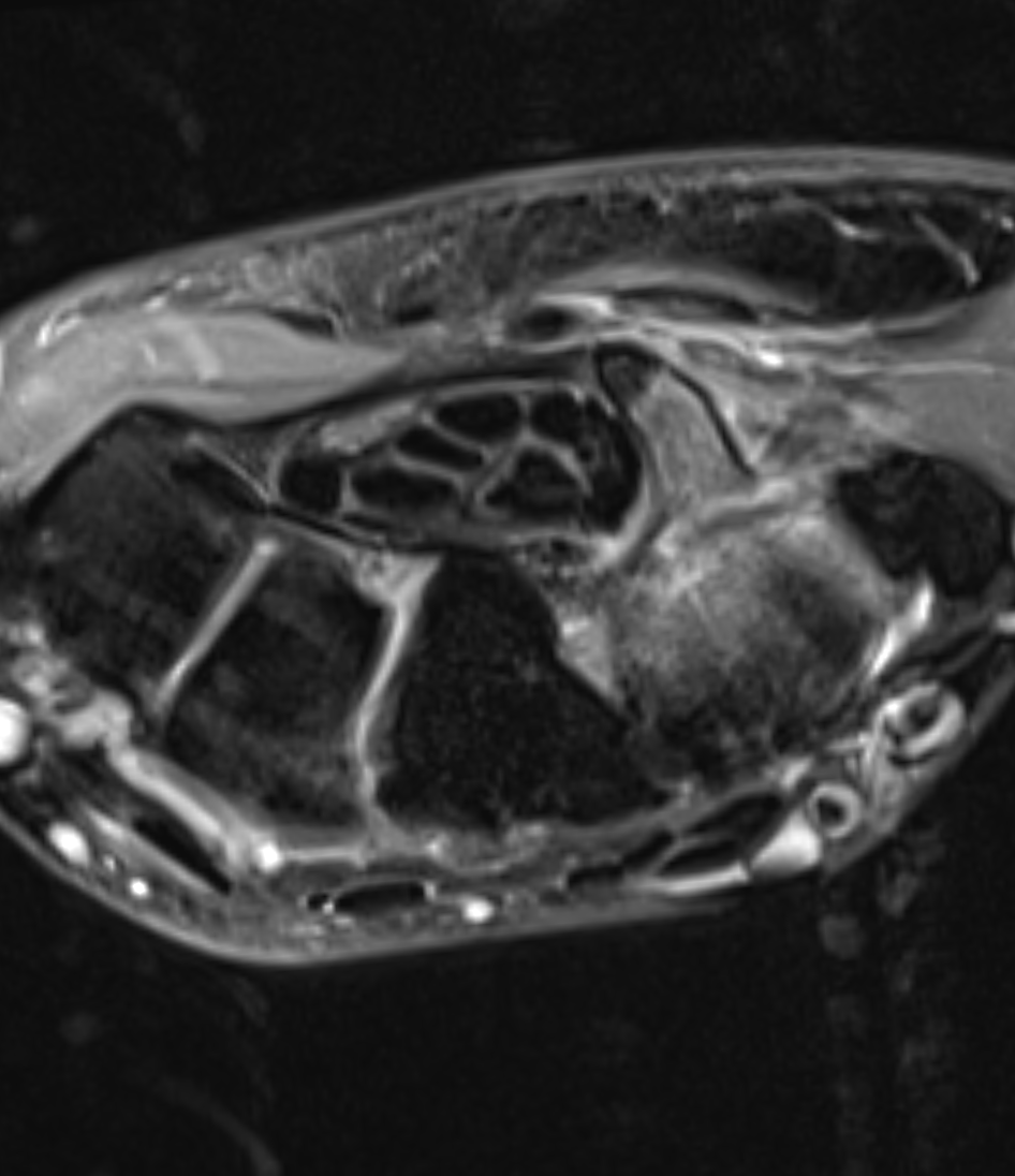  Hook_Of_Hamate_Fracture  Click for DICOM 