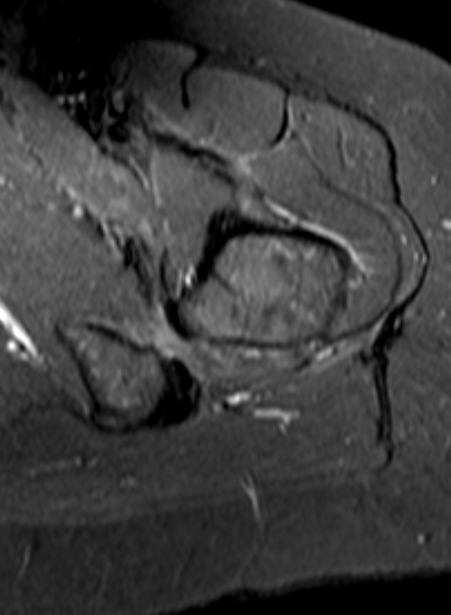 
Ischiofemoral impingement. Click for DICOM
