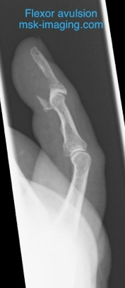 

Flexor profundus avulsion. Zone 

