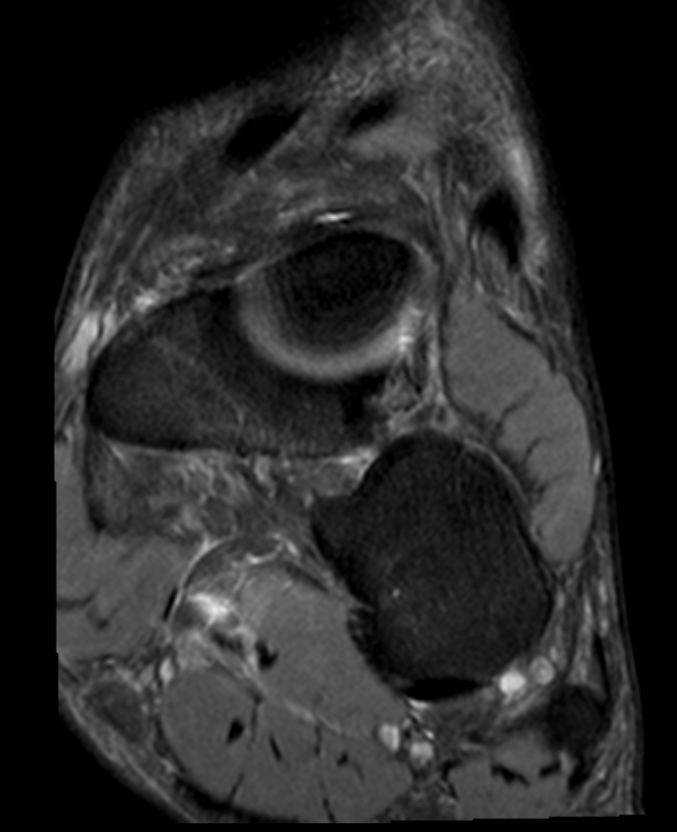 
Crossover impingement at Knot of Henry. Click for DICOM
