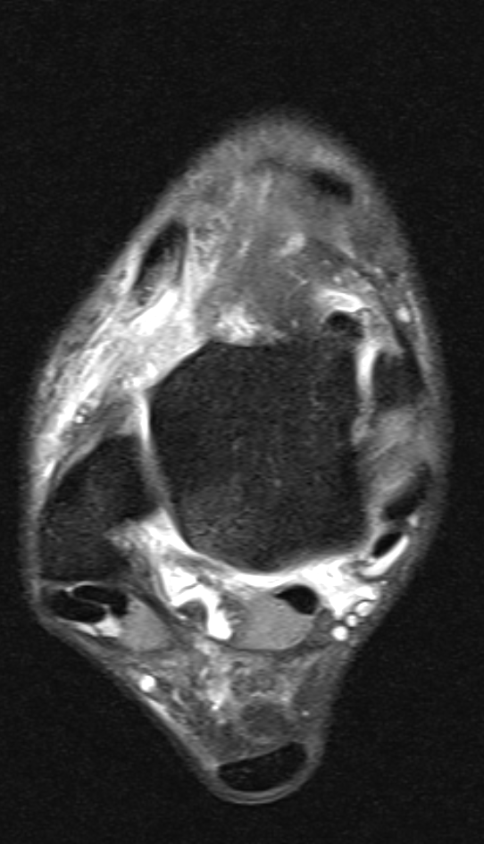 
Lateral ligament injuries. Click for DICOM