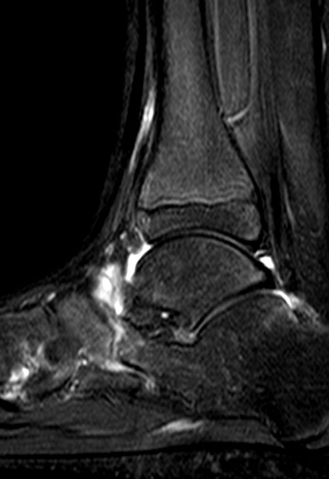 
Non osseus calcaneonavicular coalition. Click for DICOM
