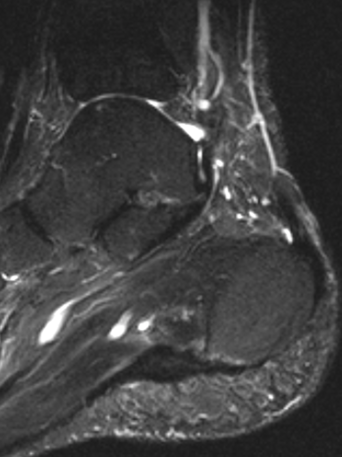 
Plantar fascia cuboid tunnel
