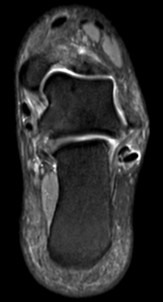 
Peroneal tenosynovitis. Click for DICOM
