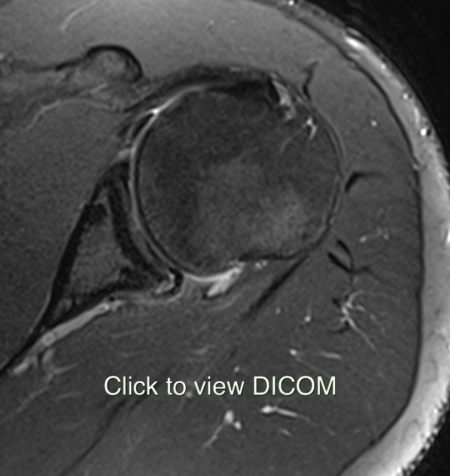 Posterior labral tear