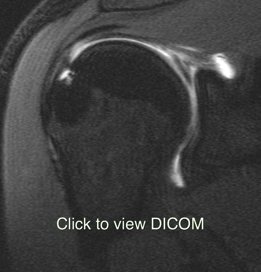 Posterosuperior ganglion