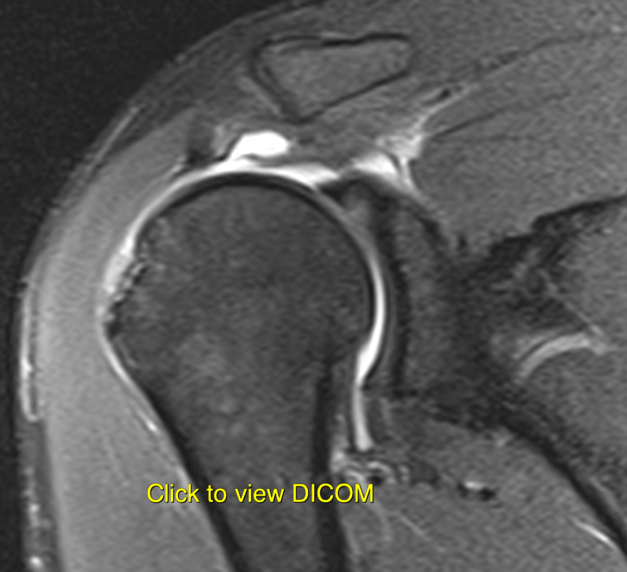 SASD Bursitis