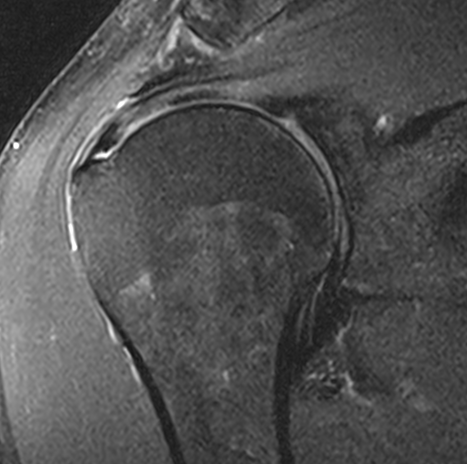 Rim rent partial tear