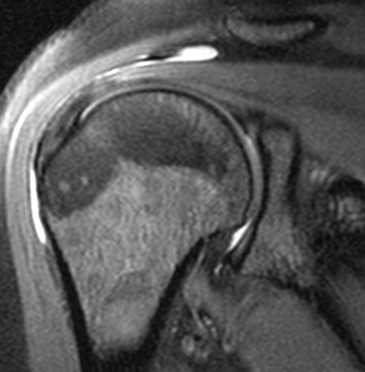 SASD Bursitis