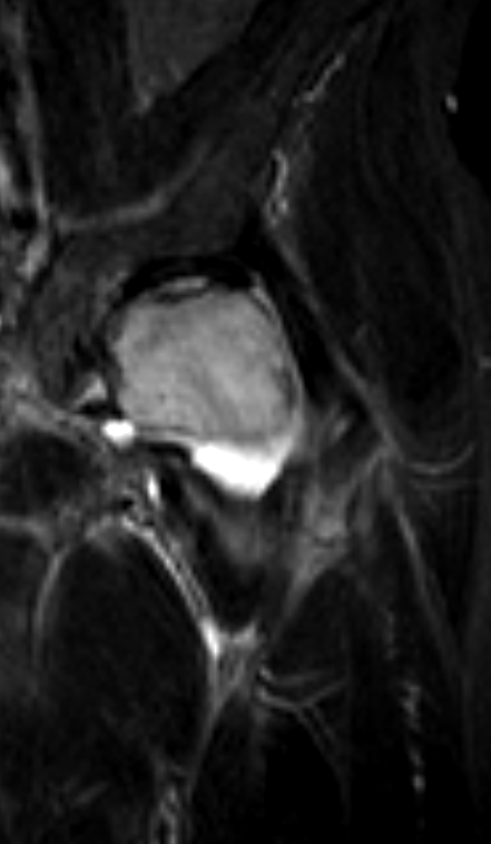  Transient osteoporosis and insufficiency fracture. . Click for DICOM