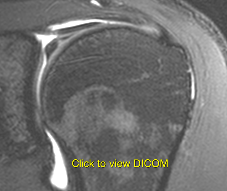 SLAP lesion overview