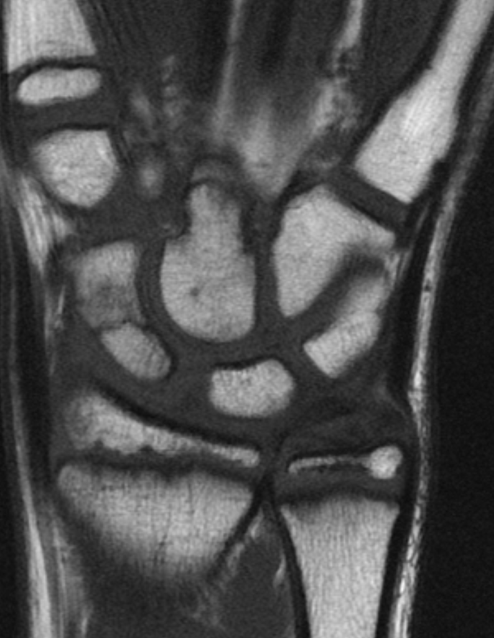  SCAPHOID FRACTURE. Click for DICOM 