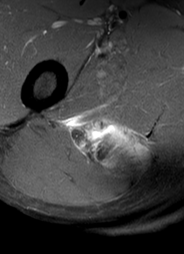 
Sciatic compression haematoma. Click for DICOM
