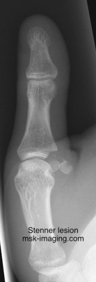 

Avulsion fracture of UCLt displaced proximally and outside the adductor aponeurosis

