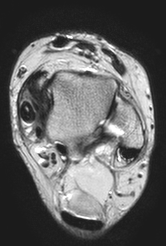 
Tibialis posterior tendinopathy. Click for DICOM
