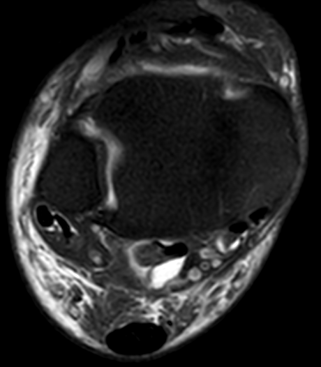 
Tibialis posterior tendinopathy. Click for DICOM
