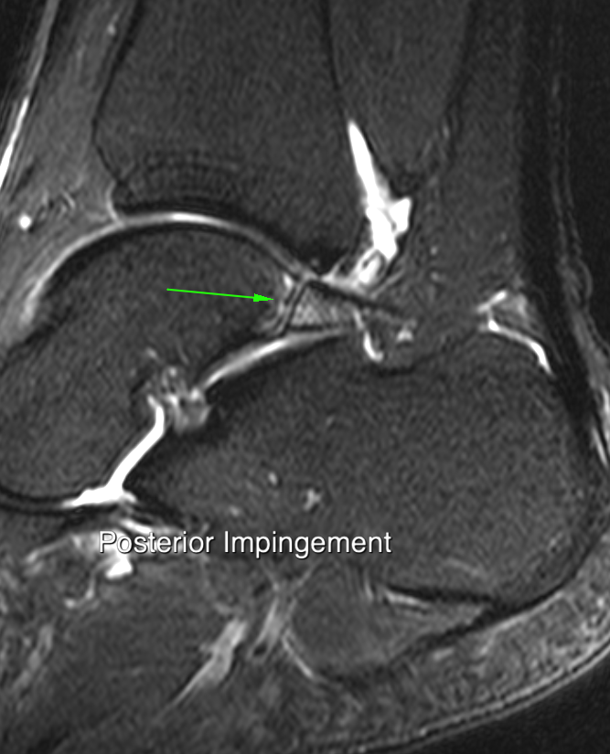 
Posterior impingement. Click for DICOM
