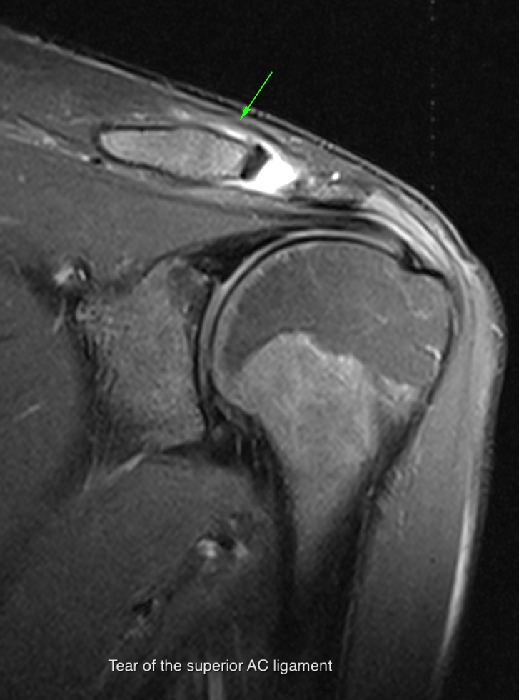 AC Joint case 2