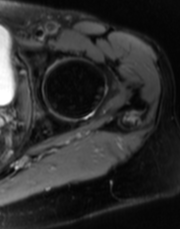 
Gmed tendinopathy. Click for DICOM
