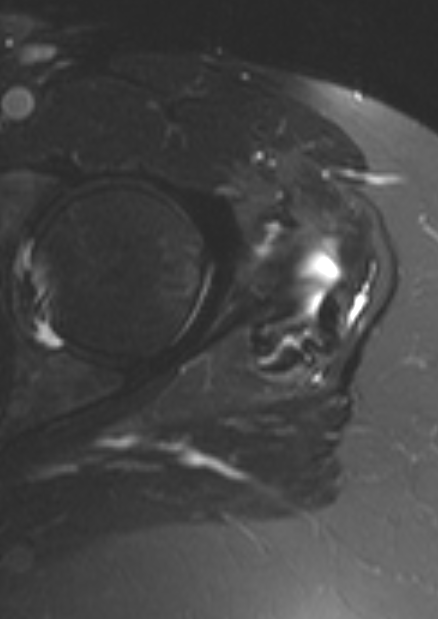 
Two Gluteal bursae. Click for DICOM
