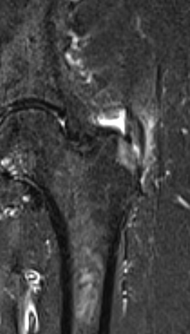
Gluteal insertion disease. Click for DICOM
