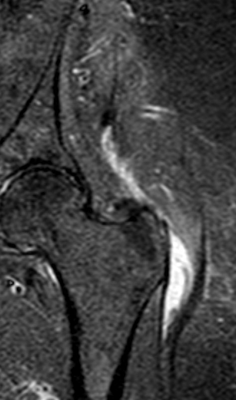 
Gluteus medius tear. Click for DICOM
