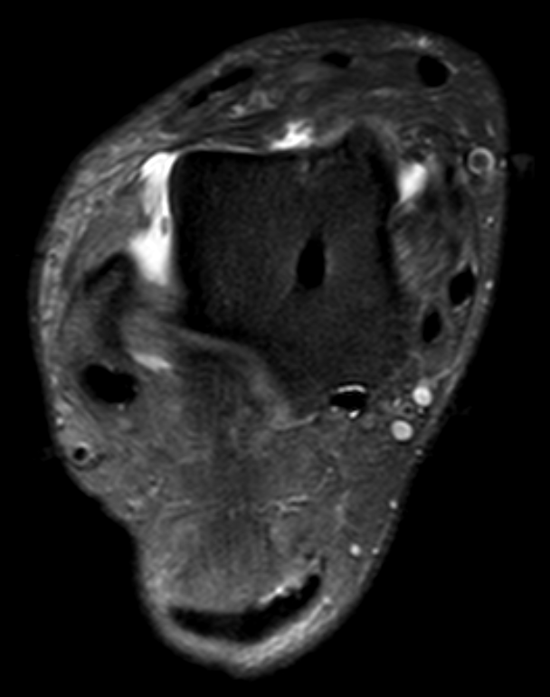 
ATFL tear. Click for DICOM
