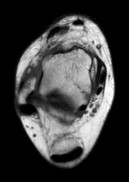 
Lateral ligament tear ATFL. Click for DICOM
