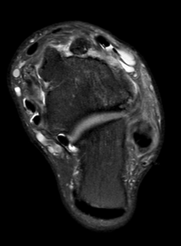 
Extensor and peroneal tenosynovitis. Click for DICOM
