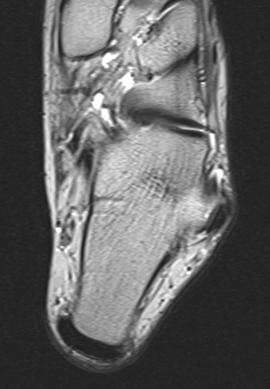 
Enlarged peroneal tubercle. Click for DICOM
