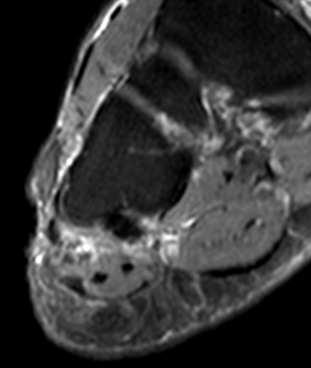 
 Lateral bundle plantar fasciitis. Click for DICOM
