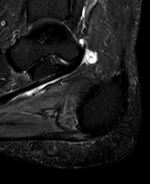
Achilles tendinopathy and plantar fasciitis. Click for DICOM
