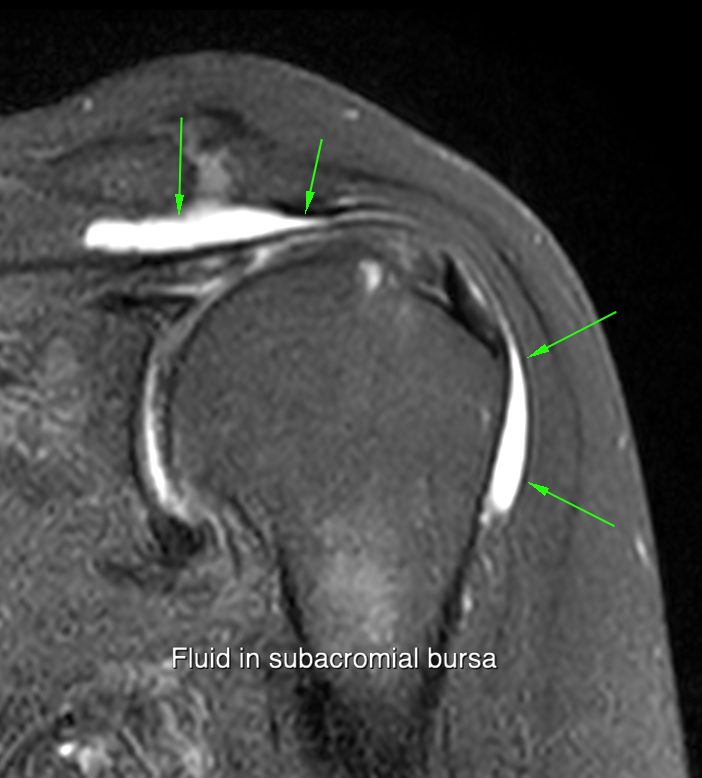 Acromial morphology
