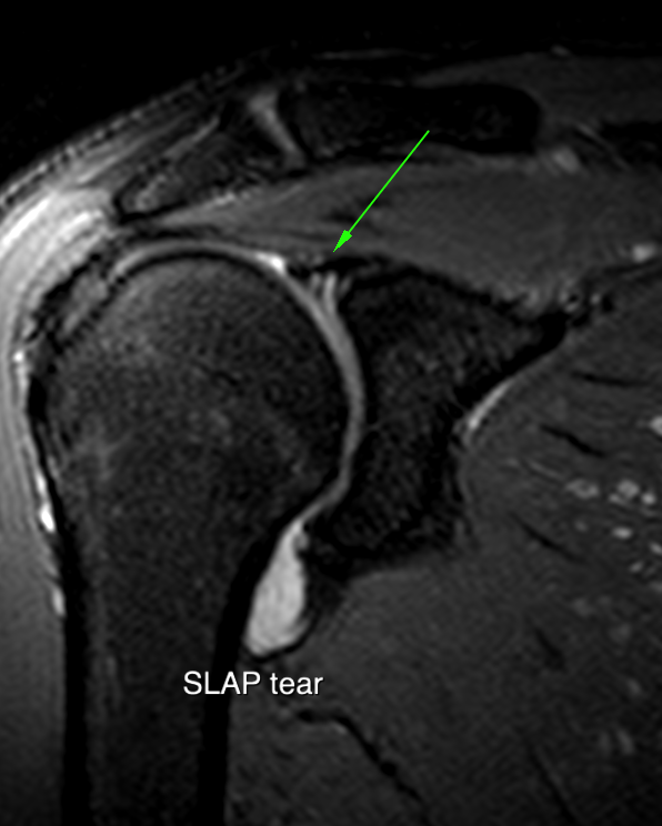 SLAP case 3