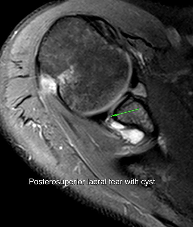 PSI case 1