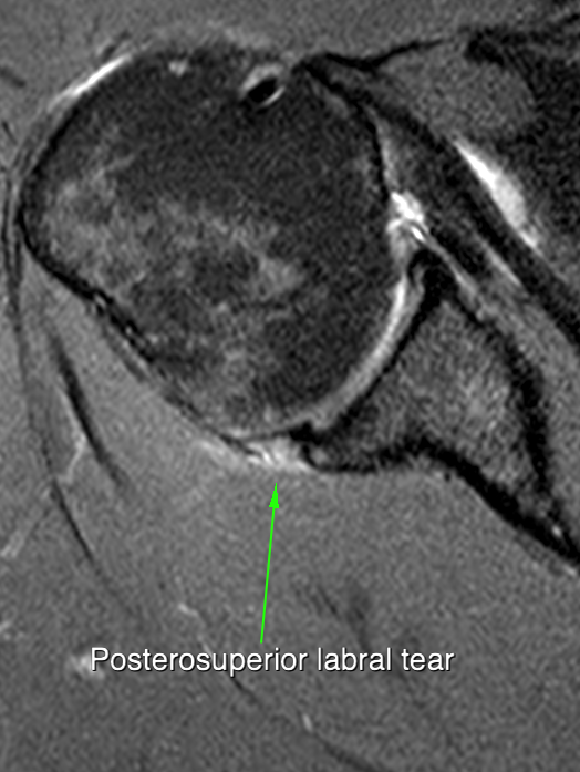 PSI case 2